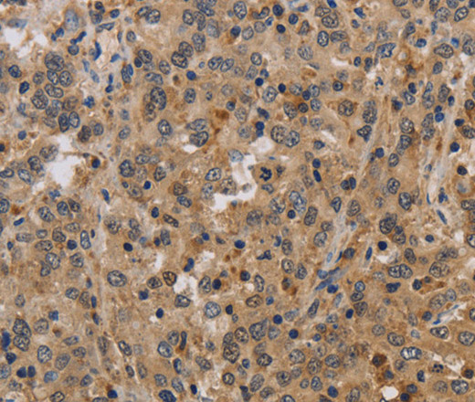 Immunohistochemistry of paraffin-embedded Human liver cancer tissue using ELAVL2 Polyclonal Antibody at dilution 1:40