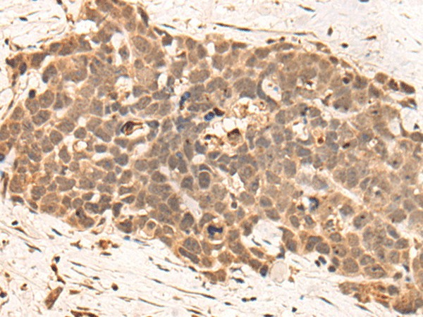 Immunohistochemistry of paraffin-embedded Human thyroid cancer tissue  using CLK2 Polyclonal Antibody at dilution of 1:45(?200)