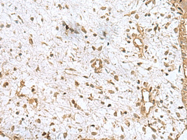 Immunohistochemistry of paraffin-embedded Human breast cancer tissue  using AK6 Polyclonal Antibody at dilution of 1:90(?200)