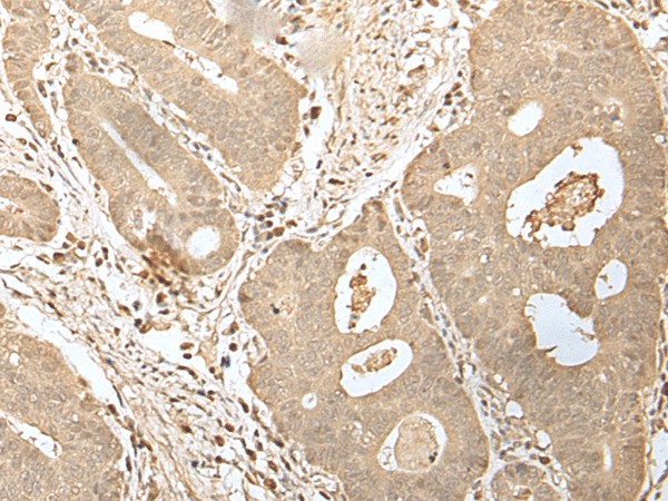 Immunohistochemistry of paraffin-embedded Human gastric cancer tissue  using HDHD2 Polyclonal Antibody at dilution of 1:40(?200)