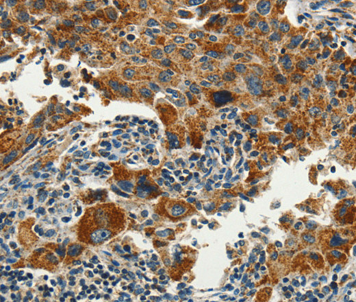 Immunohistochemistry of paraffin-embedded Human lung cancer using SERPINA9 Polyclonal Antibody at dilution of 1:60