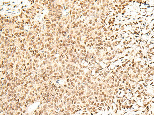 Immunohistochemistry of paraffin-embedded Human ovarian cancer tissue  using FKBP5 Polyclonal Antibody at dilution of 1:50(?200)