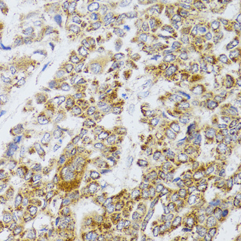 Immunohistochemistry of paraffin-embedded Human liver cancer using AIFM3 Polyclonal Antibody at dilution of 1:100 (40x lens).