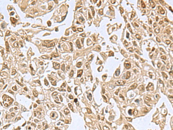 Immunohistochemistry of paraffin-embedded Human lung cancer tissue  using NVL Polyclonal Antibody at dilution of 1:80(?200)