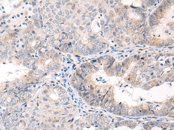 Immunohistochemistry of paraffin-embedded Human ovarian cancer tissue  using ANAPC15 Polyclonal Antibody at dilution of 1:70(?200)