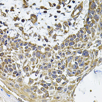 Immunohistochemistry of paraffin-embedded Human skin carcinoma using ICOSL Polyclonal Antibody at dilution of 1:100 (40x lens).