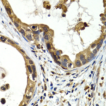 Immunohistochemistry of paraffin-embedded Human gastric cancer using CTSS Polyclonal Antibody at dilution of 1:200 (40x lens).