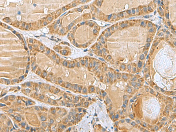 Immunohistochemistry of paraffin-embedded Human thyroid cancer tissue  using MRPL40 Polyclonal Antibody at dilution of 1:80(?200)