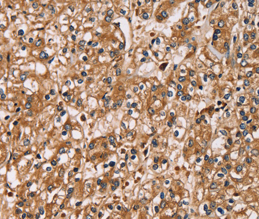 Immunohistochemistry of paraffin-embedded Human prostate cancer using HTR3C Polyclonal Antibody at dilution of 1:30