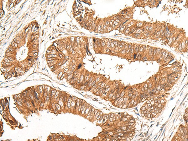 Immunohistochemistry of paraffin-embedded Human colorectal cancer tissue  using GFI1 Polyclonal Antibody at dilution of 1:100(?200)