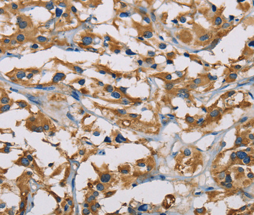 Immunohistochemistry of paraffin-embedded Human thyroid cancer using PIP4K2A Polyclonal Antibody at dilution of 1:50