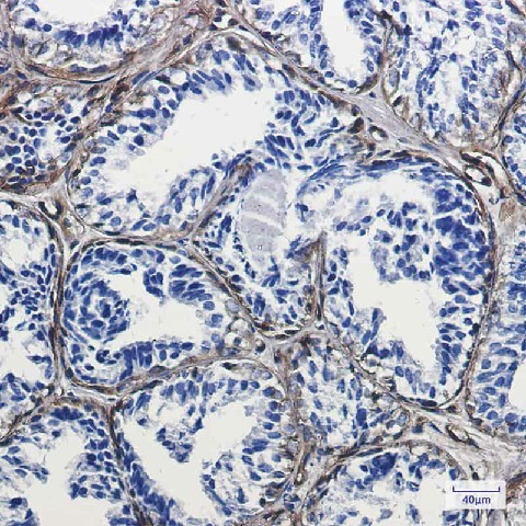 Immunohistochemistry of Caveolin-1 in paraffin-embedded Human breast cancer tissue using Caveolin-1 Rabbit mAb at dilution 1:100