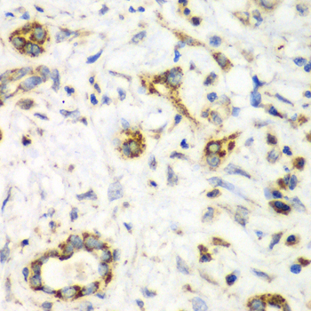 Immunohistochemistry of paraffin-embedded Human liver cancer using NRBF2 Polyclonal Antibody at dilution of 1:100 (40x lens).