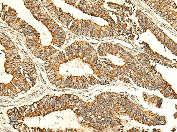 Immunohistochemistry of paraffin-embedded Human colorectal cancer tissue  using ATP5PD Polyclonal Antibody at dilution of 1:50(?200)